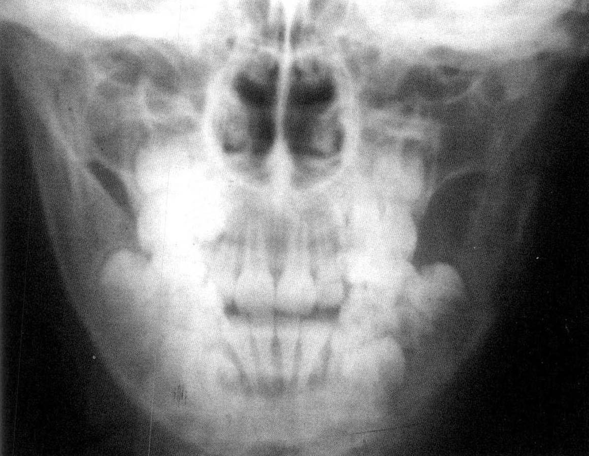 鼻旁窦的 X 射线图像用于诊断鼻窦炎。高清摄影大图-千库网